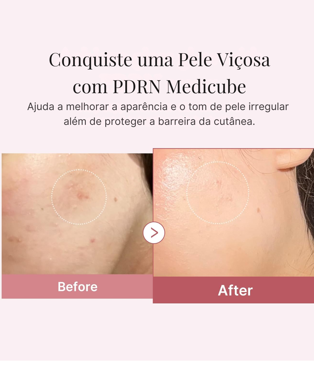 Medicube com Ácido Hialurônico Creme Hidratante Rosa PDRN | Recuperação de Imperfeições e Hidratação Profunda