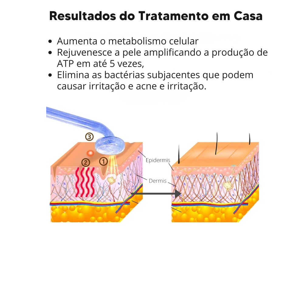 Aparelho de Alta Frequência DARSONVAL- 6 em 1, Terapia Facial Anti Sinais, Acne e Cabelo